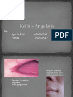 Cheilitis Angularis Versi 2003