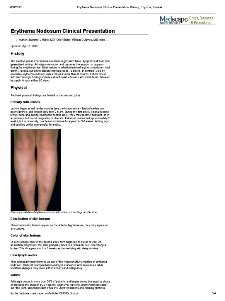 Erythema Nodosum Clinical Presentation_ History, Physical, Causes