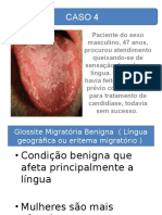 Patologia Oral - Glossite Migrátoria Benigna