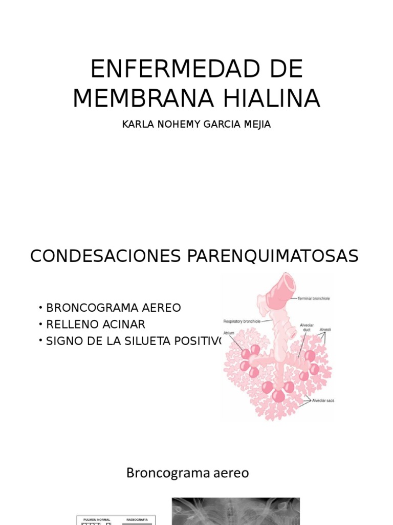 Clasificacion en RX de La Enfermedad de Membrana Hialina PDF
