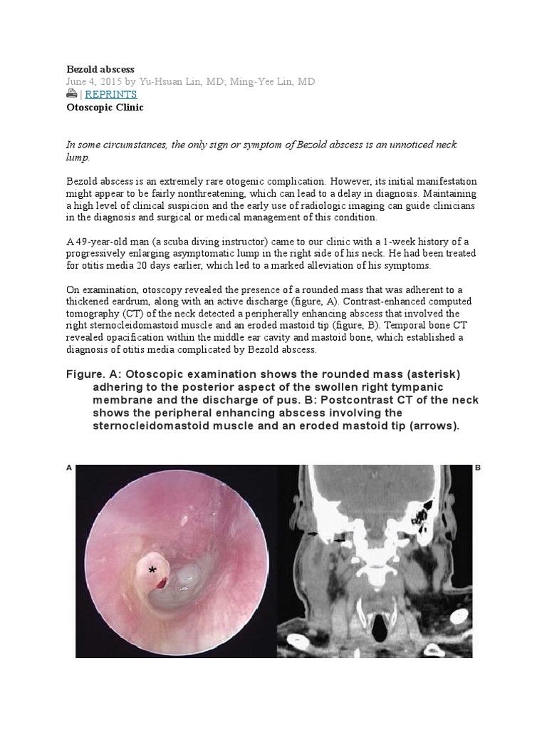Bezold Abscess Ear Medical Specialties