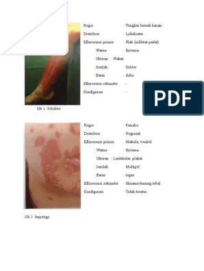 Pikkelysömör okai, kezelése - Dr Harmos Ferenc bőrgyógyász