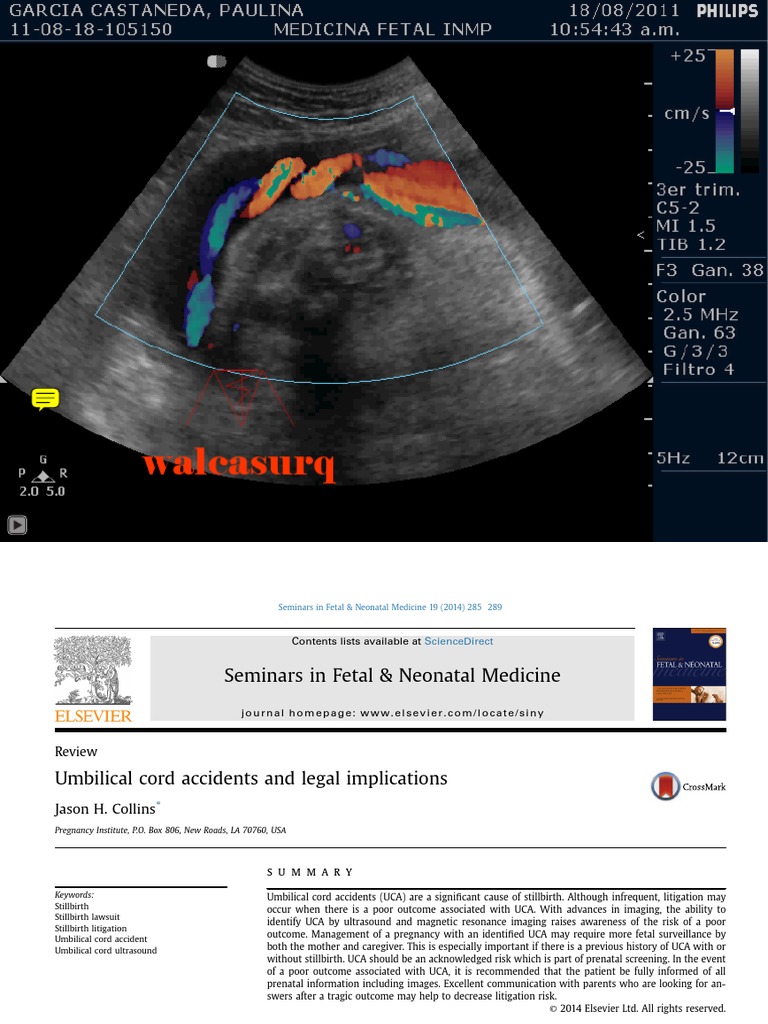Umbilical Cord Accidents and Legal Implications Edit 14 Download Free