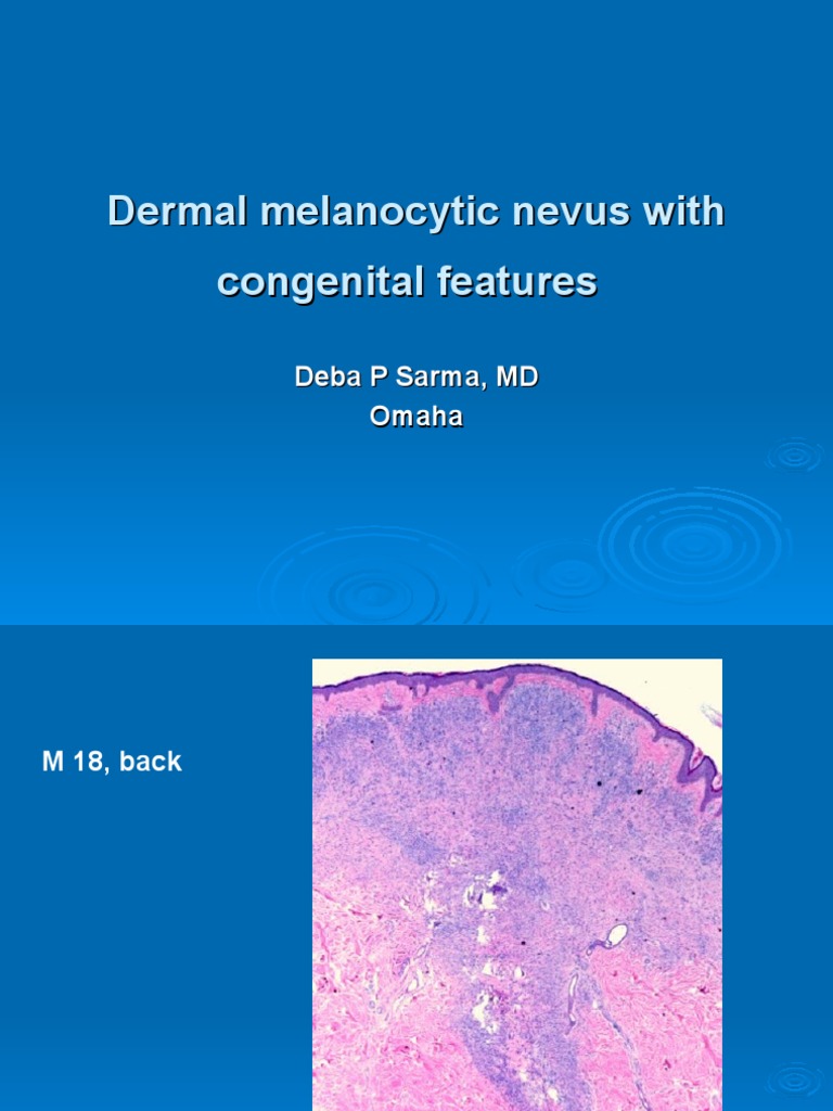 Congenital Dermal Melanocytic Nevus | PDF