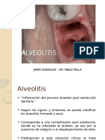 Alveolitis post extracción: diagnóstico y tratamiento