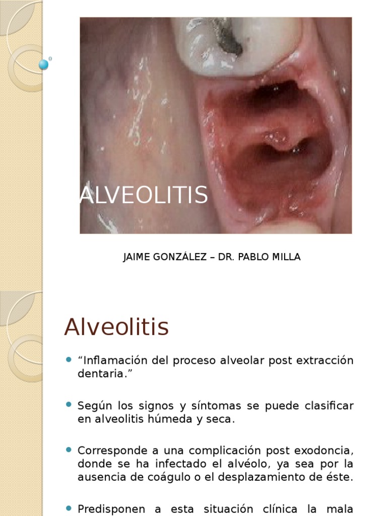 Alveolitis 130527180045 Phpapp02 Pdf Especialidades Medicas Enfermedades Y Trastornos 
