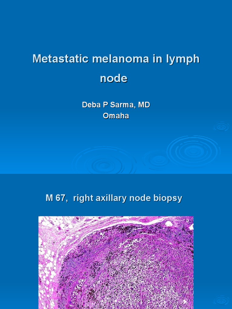 Metastatic Melanoma in Right Axillary Lymph Node, M 67. | PDF