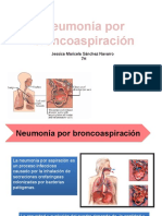 Neumonía por aspiración