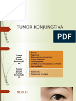 Tumor Konjungtiva