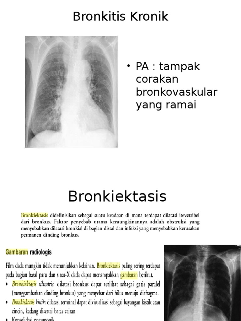 Hasil Rontgen Bronkitis Kronis | PDF | Seni
