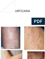 Urticaria