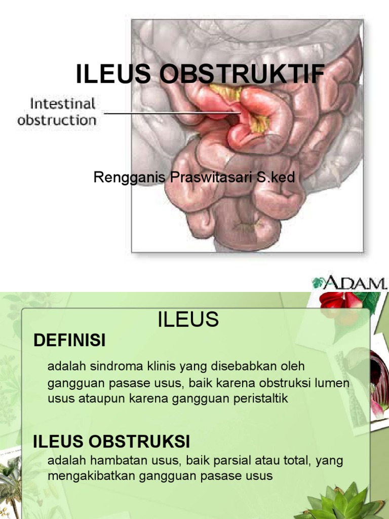 Ileus Obstruktif PDF