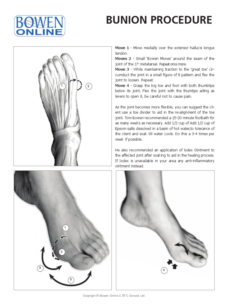 Bunion Procedure: Online | PDF