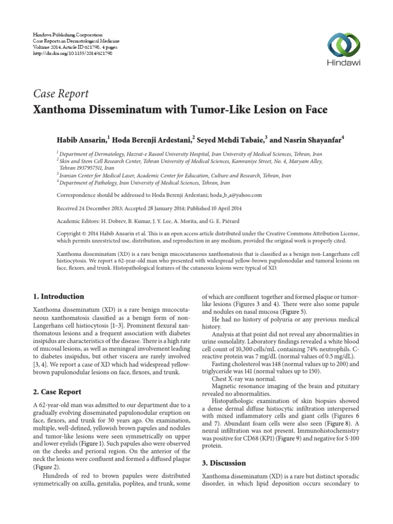 Case Report Xanthoma Disseminatum With TumorLike Lesion On Face PDF