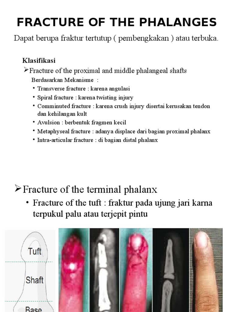 Fracture of The Phalanges | PDF