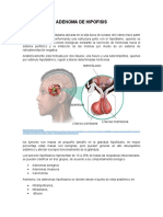 Adenoma de Hipofisis