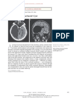 Arachnoid Cyst: Images in Clinical Medicine