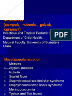 Measles (Campak, Rubeola, Gabak, Kerumut)