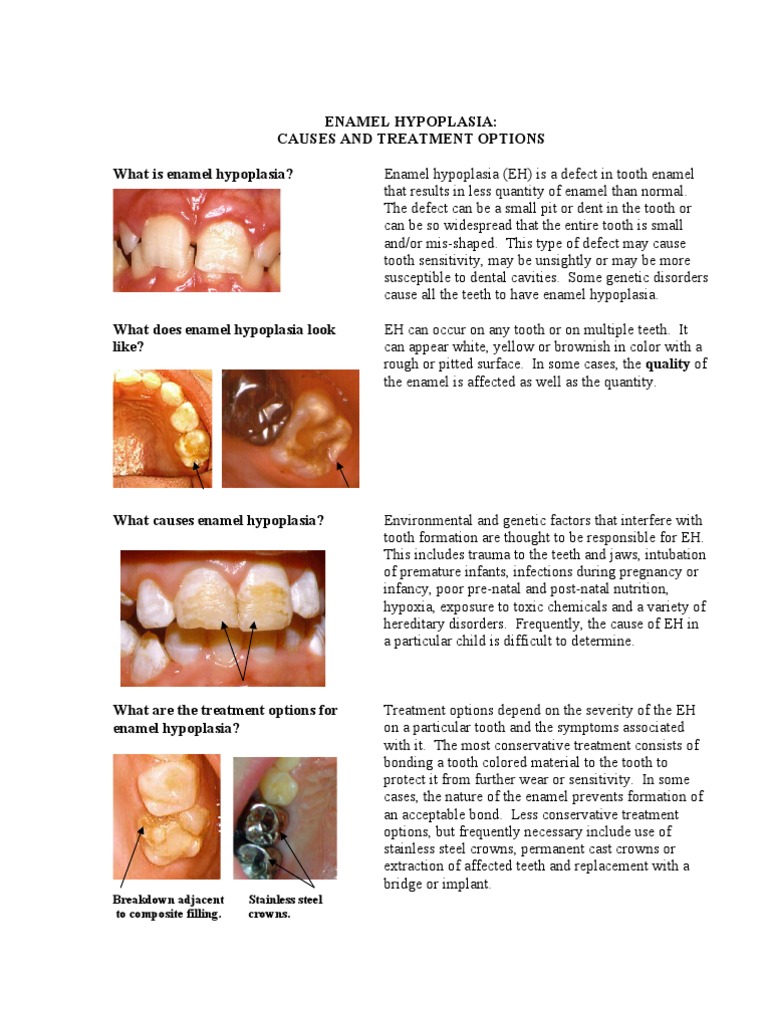 Enamel Hypoplasia PDF Human Tooth Tooth Enamel