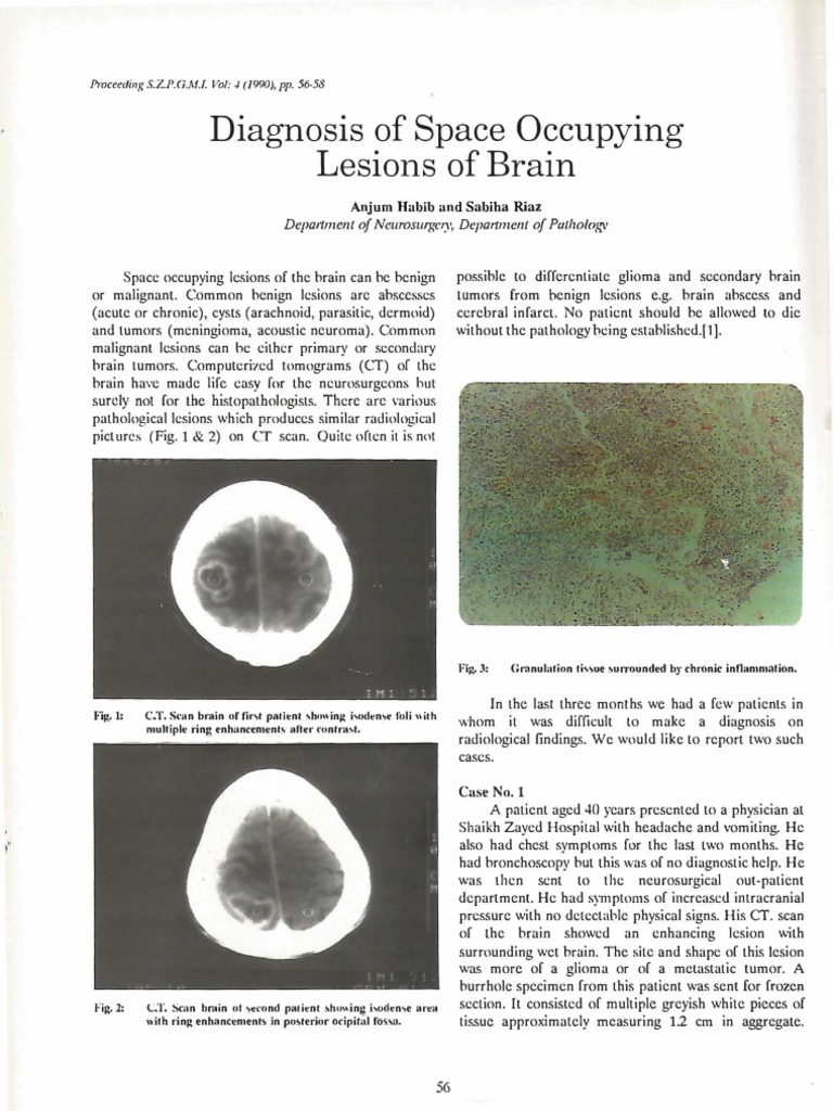 Diagnosis of Space Occupying Lesions of Brain | Brain Tumor | Carcinoma