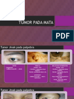 Tumor Pada Mata