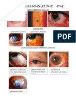 Cuerpos Extraños en El Ojo