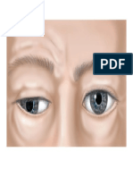 3rd Nerve Palsy