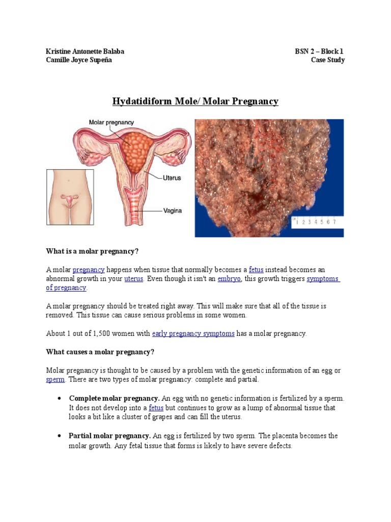 Hydatidiform Mole | PDF | Pregnancy | Miscarriage