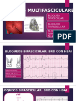 Bloqueos Multifasiculares