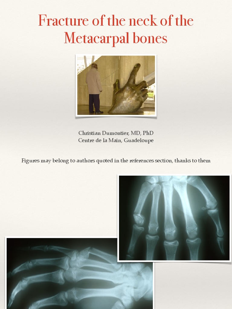3-2 Metacarpal Neck Fractures | PDF | Hand | Musculoskeletal System