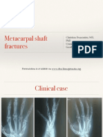 3-2 Metacarpal Shaft Fractures