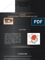 Glaucoma