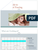 Fetal Heart Tracing