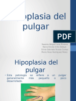 Hipoplasia Del Pulgar