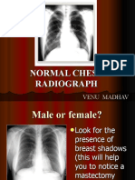 Normal Chest Radiograph
