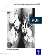 69-Year-Old Woman With Guaiac-Positive Stool-Benign Cause of Pneumatosis Intestinalis (PI)