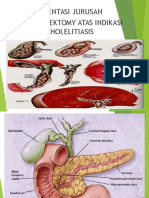 Kolelitiasis