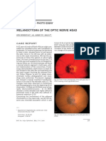 Melanocytoma of The Optic Nerve Head: Clinical Case - Photo Essay