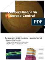 Coriorretinopatía Serosa Central