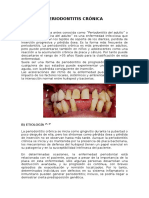 Periodontitis Crónica