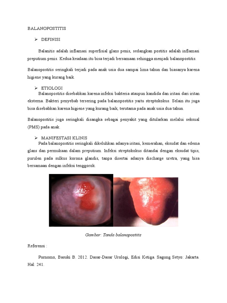 Balanopostitis: Gejala dan Penyebabnya | PDF