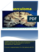 Tuberculoma 