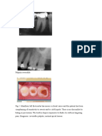 Document2 Pulpitis