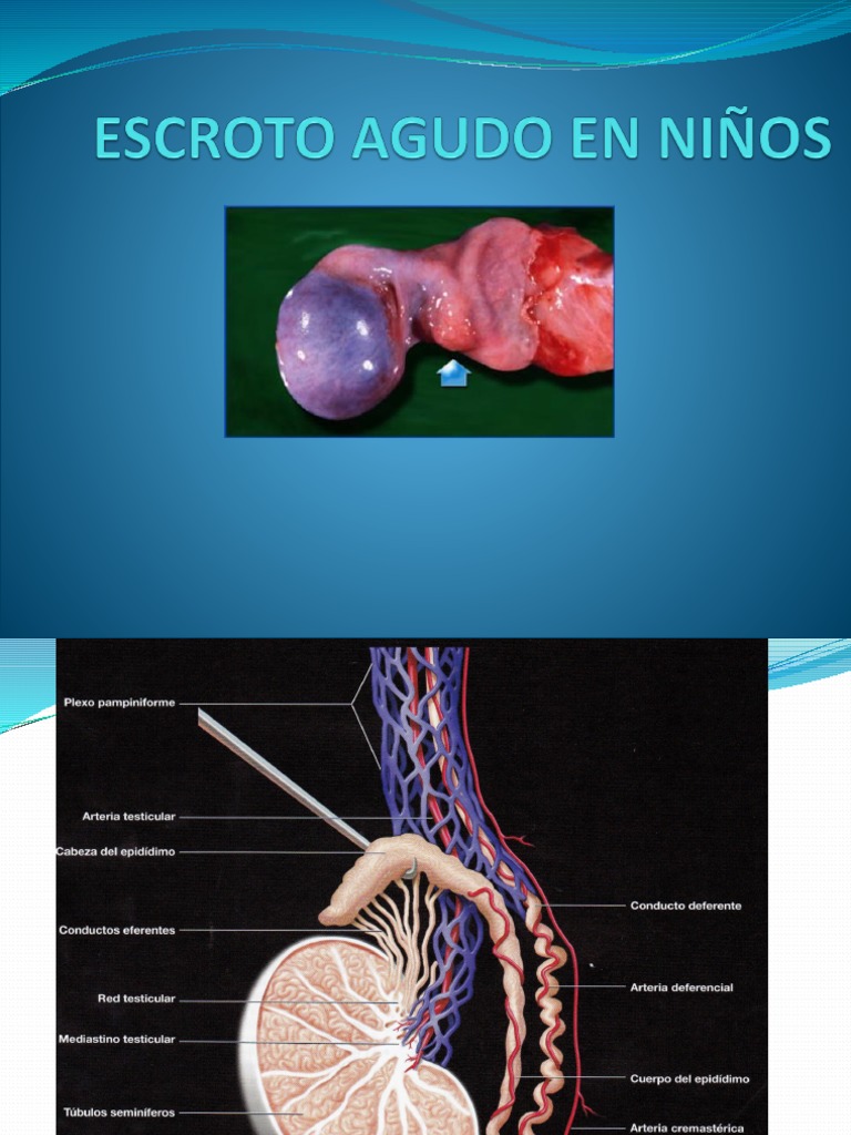 Torsión Testicular y Escroto Agudo en Niños | PDF | Testículo ...
