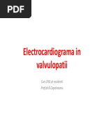 LITFL - Wellens Syndrome | PDF | Myocardial Infarction ...