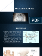 Displasia de Cadera