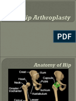 Hip Replacement