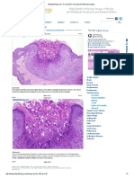 Molluscum Contagiosum: Tweets