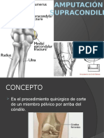 Diapositiva de La Amputacion Supracondilia