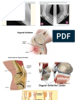 Enfermedad de Osgood Shlatter